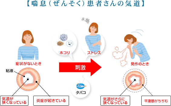 喘息（ぜんそく）患者さんの気道